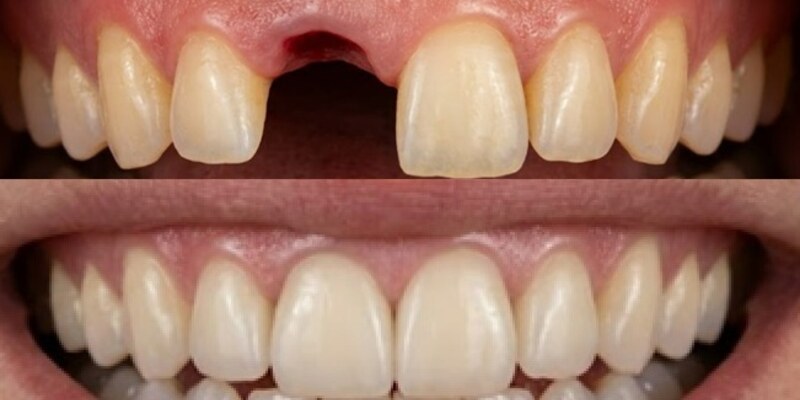 Dental implants before and after at Seren Dental